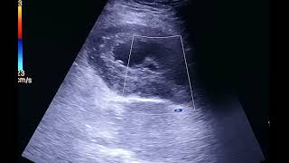 Case of postmenopausal bleeding [upl. by Anomar]