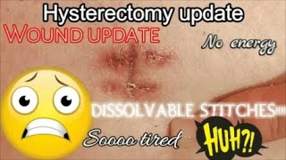 HYSTERECTOMY UPDATE  WEEK 45 POST OP [upl. by Lawry]