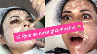 12 iğne ile yüzüme yaptığım cilt bakımı [upl. by Adli]