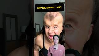 How to operate CRANIOSYNOSTOSIS  Surge On Ph [upl. by Mihar]