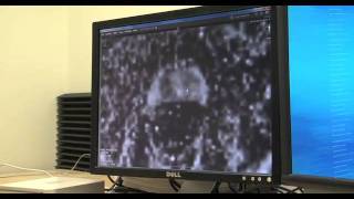 Prostate Biopsy Targeted Biopsy Using MRUltrasound Fusion [upl. by Jaimie]