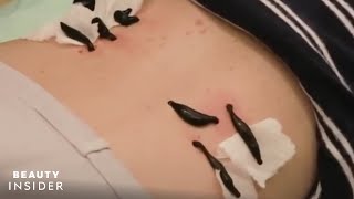 Removing Leeches in Hirudotherapy Medical Leech Therapy on Ears amp Neck Hirudo Verbana Medicinalis [upl. by Elleynad]