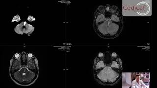 Caso Clínico Micro angiopatia Cerebral Infartos Lacunares Multiples Dr Jorge Ivan Ospina [upl. by Obeng]