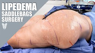 Lipedema Reduction Surgery Thighs amp Buttocks  Total Lipedema Care [upl. by Alleinad46]