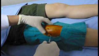 Knee aspiration technique Knee synovitis เจาะเข่า เข่าอักเสบ [upl. by Cowie316]