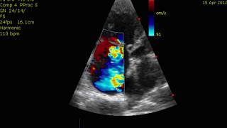 Echocardiogram Cor Pulmonale PHTN Pulmonary Hypertension [upl. by Martyn]