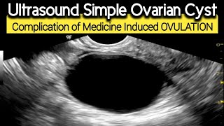 Ultrasound Simple Ovarian CYST  Complication of Medication induced Ovulation [upl. by Nahtad]