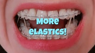 How I put my Braces Elastics on [upl. by Nwahsel]