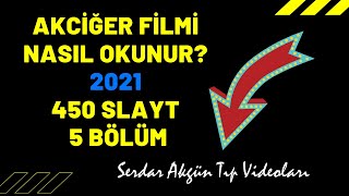 Radyoloji Akciğer filmi nasıl okunur 2bölüm Serdar Akgün [upl. by Ymirej]