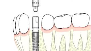 ANKYLOS Surgical and Prosthetic procedure [upl. by Aicilaana]