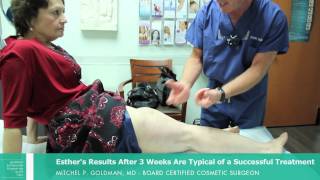 Sclerotherapy San Diego Patient Experience  Dr Mitchel P Goldman [upl. by Arnaud730]