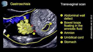 Gastroschisis [upl. by Bray]