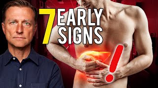 7 Early Signs of Liver Damage [upl. by Abelard769]