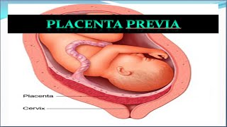 Placenta Previa Update [upl. by Aihppa61]