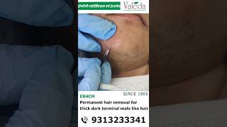 Permanent Hair Removal for thick dark terminal male like hair viralshorts [upl. by Cuthburt]