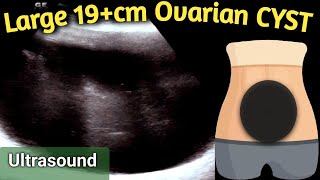 Ultrasound 19 cm Large Ovarian Cyst  equal to size of Handball in Abdomen [upl. by Ecirtam171]