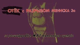 ОТЁК коленного сустава с РАЗРЫВОМ МЕНИСКА 3 степени по stoller на РАСШИФРОВКЕ МРТ коленного сустава [upl. by Laekcim182]