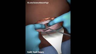 cesarean section  c section animation [upl. by Engamrahc]