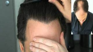 wwwhattingenhaircom  Result 4121 Grafts [upl. by Jeffie]