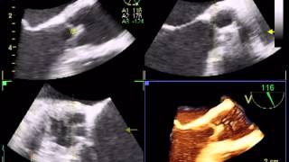 AORTIC FLAIL  ROLE OF 3D TEE [upl. by Mary]