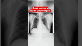 CARDIOMEGALIA DOLOR TORÁCICO Y DISNEA [upl. by Mittel231]