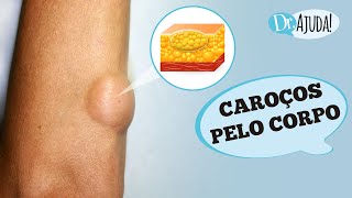 CAROÇOS DE GORDURA NA PELE E LIPOMA O QUE SÃO O QUE REPARAR [upl. by Ettenawtna]