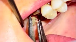 Complicated Molar Extraction ASMR [upl. by Llerryt833]