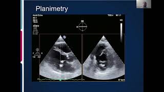 Joint Echo Conference Mitral Stenosis [upl. by Zoeller]