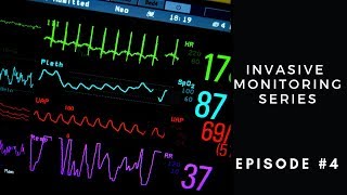 Invasive Monitoring Series Episode 4 Stroke Volume Variation [upl. by Arries]