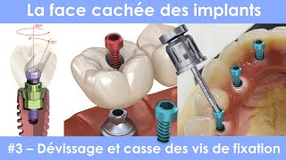 La face cachée des implants dentaires  3  dévissage et casse des vis de fixation [upl. by Millman]