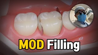 Dental Filling Procedure  MOD Molar Composite Restoration [upl. by Ennove]