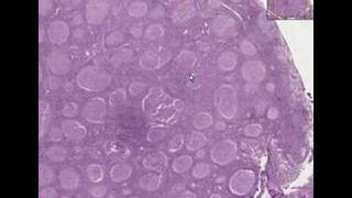 Histopathology Lymph node Follicular lymphoma grade 2 [upl. by Nyar]