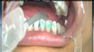 Profilaxia  Limpeza dental [upl. by Horsey]