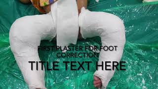 Correcting Clubfoot The Ponseti Method in English accent from USA [upl. by Swirsky]