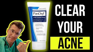 Benzac ac 25 review  benzoyl peroxide for acne  benzoyl peroxide gel  acne treatment [upl. by Nyvets221]