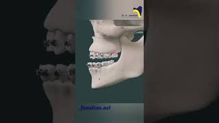 Le Fort I osteotomy for maxillary advancement dentistOsteotomy orthodontistMaxillaryAdvancement [upl. by Netram879]