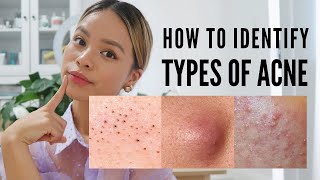 How to treat EVERY type of acne With Pictures [upl. by Nali]