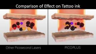 Luntronic PICOPLUS Laser FDA approved Picosecond amp Nanosecond Platform [upl. by Ojok91]