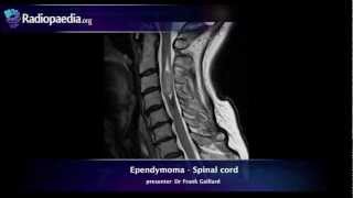 Spinal ependymoma  radiology video tutorial MRI [upl. by Zenia]