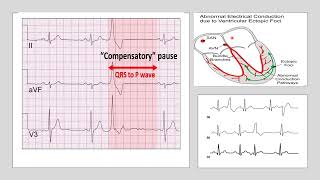 Compensatory pause occurs after Extrasystole by Prof Dr Sanhita Mukherjee [upl. by Ailehs]