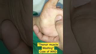 MOTOR NEURON DISEASEthenarmuscleswastingidentify diseasehandsneurologicaldisorder [upl. by Eittak]