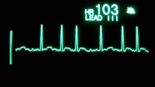 Atrial Fibrillation [upl. by Aleek]