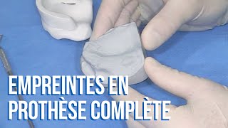 👍 Comment réussir ses empreintes secondaires en prothèse complète [upl. by Arezzini378]