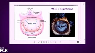 Treating diverse mitral regurgitation anatomies the power of versatility  EuroPCR 2023 [upl. by Bergmann]