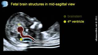 Normal fetal brain anatomy at 1113 weeks  2D scan [upl. by Kylstra]