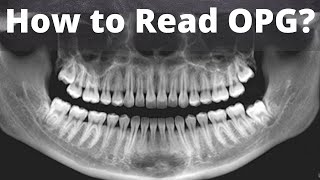 How to read Dental orthopantomogram OPG Anatomical Landmarks Indication  Oral radiology [upl. by Shelburne]