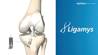 Ligamys rekonstrukcja ACL [upl. by Enileuqcaj]