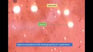 Cryptococcus capsules in Nigrosin preparation [upl. by Arliene]