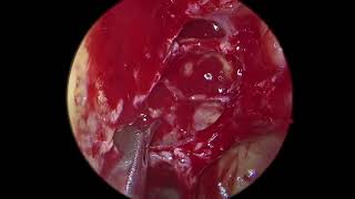 Full Functional Endoscopic Sinus Surgery FESS for sinusitis [upl. by Idissak]