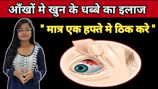 Sub Cunjuctiva Hemorrhage Treatment  Ankho Me khun ke Lal Dhabbe Ka Ilaz  In Hindi [upl. by Aday]